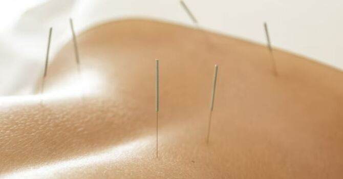 Acupuncture at Motion Pro